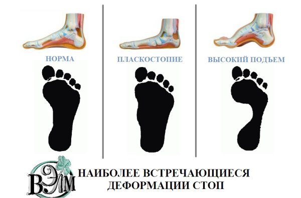 Норма стопы без плоскостопия