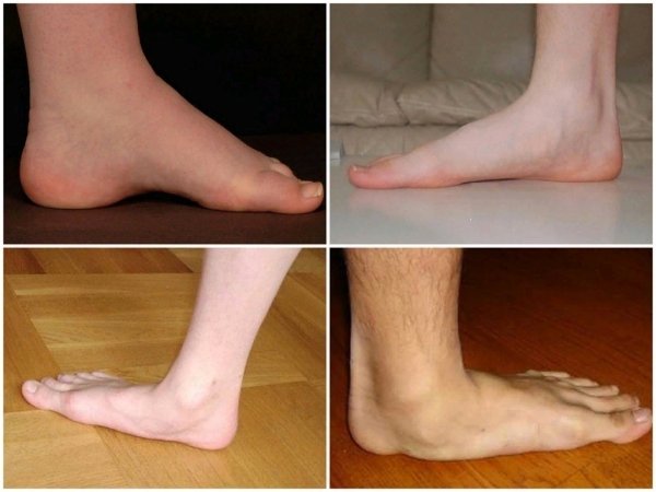 Васкулярное плоскостопие