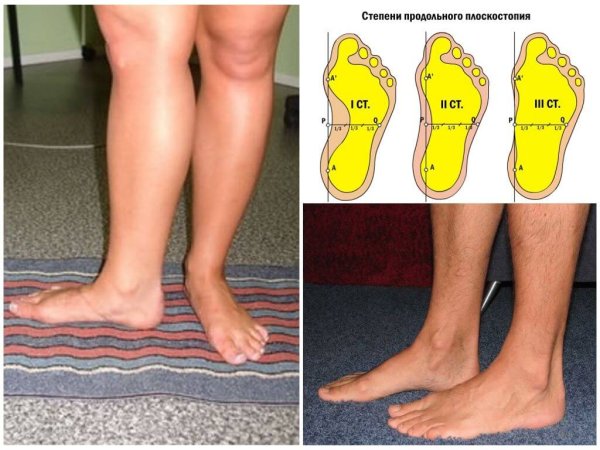 Двустороннее продольное плоскостопие 2ст