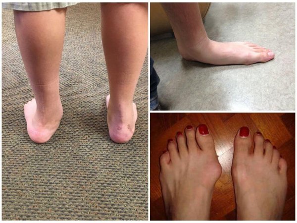 Вальгус стопы и поперечное плоскостопие