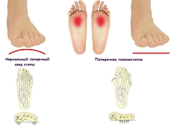 Плоскостопие поперечного свода стопы