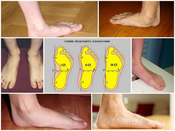 Продольно-поперечное плоскостопие и вальгус 3 степени