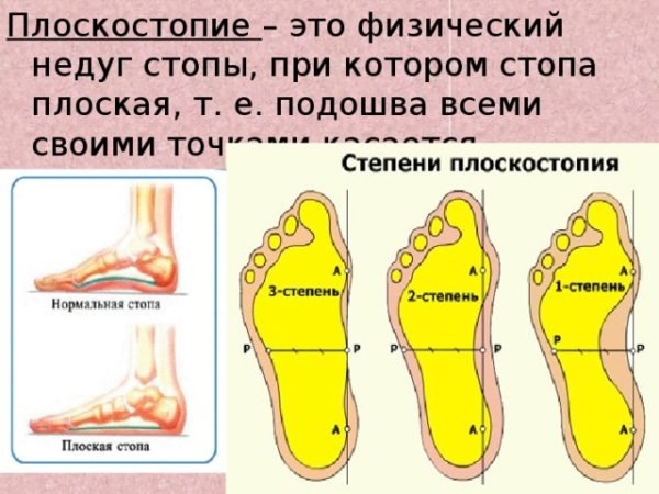 Нормальная стопа и плоскостопие