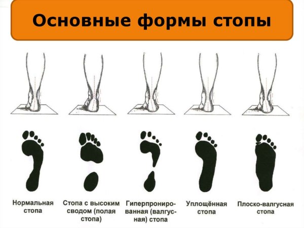 Отпечаток стопы норма и плоскостопие