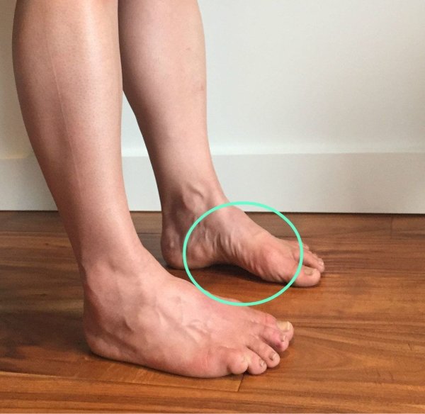 Стопа плоскостопие