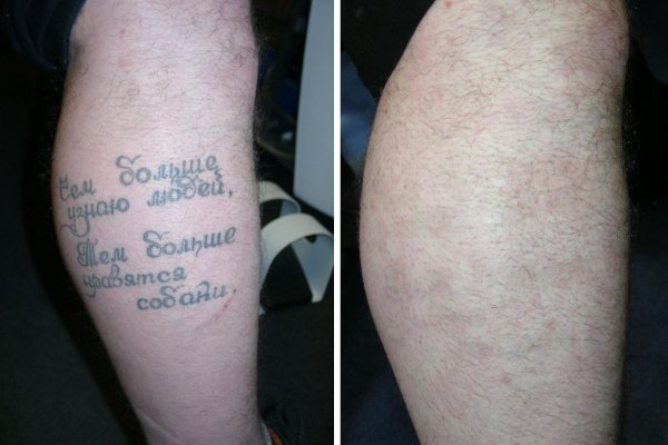 Лазерное удаление татуировок