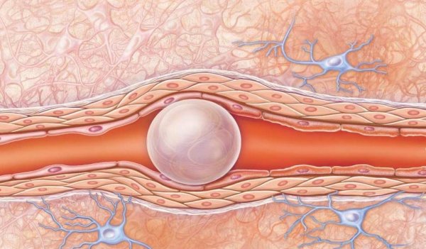 Воздушная эмболия при кровотечении