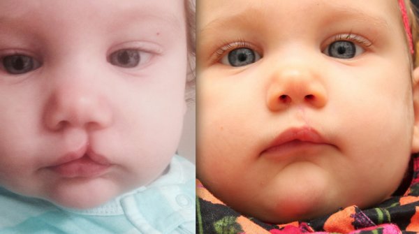 Хейлосхизис (заячья губа)