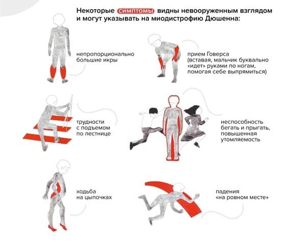 Мышечная дистрофия Дюшенна генотип