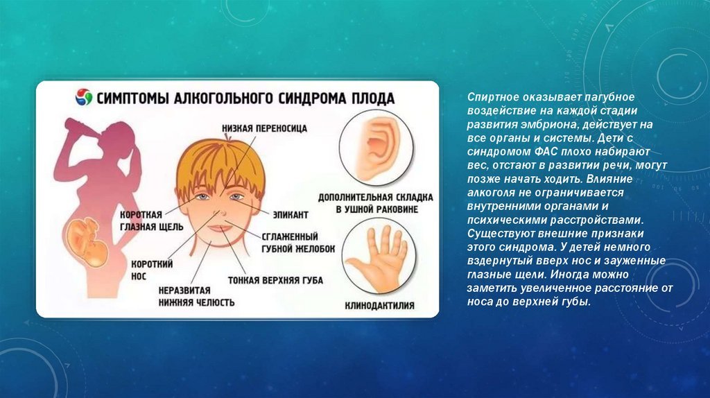 Алкогольные дети признаки. Симптомы алкогольного синдрома плода. Фетальный алкогольный синдром. Фетальный алкогольный синдром признаки.