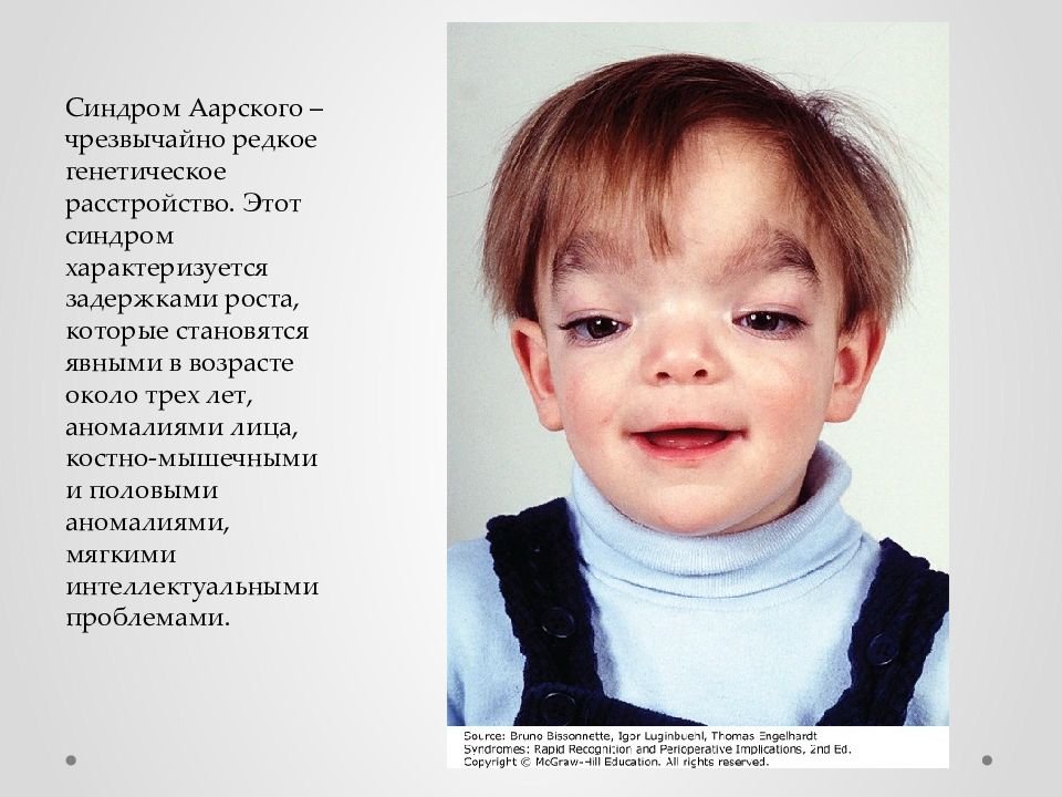 Родился какое лицо. Редкие генетические заболевания. Генетические синдромы у детей. Врожденные и наследственные заболевания у детей.