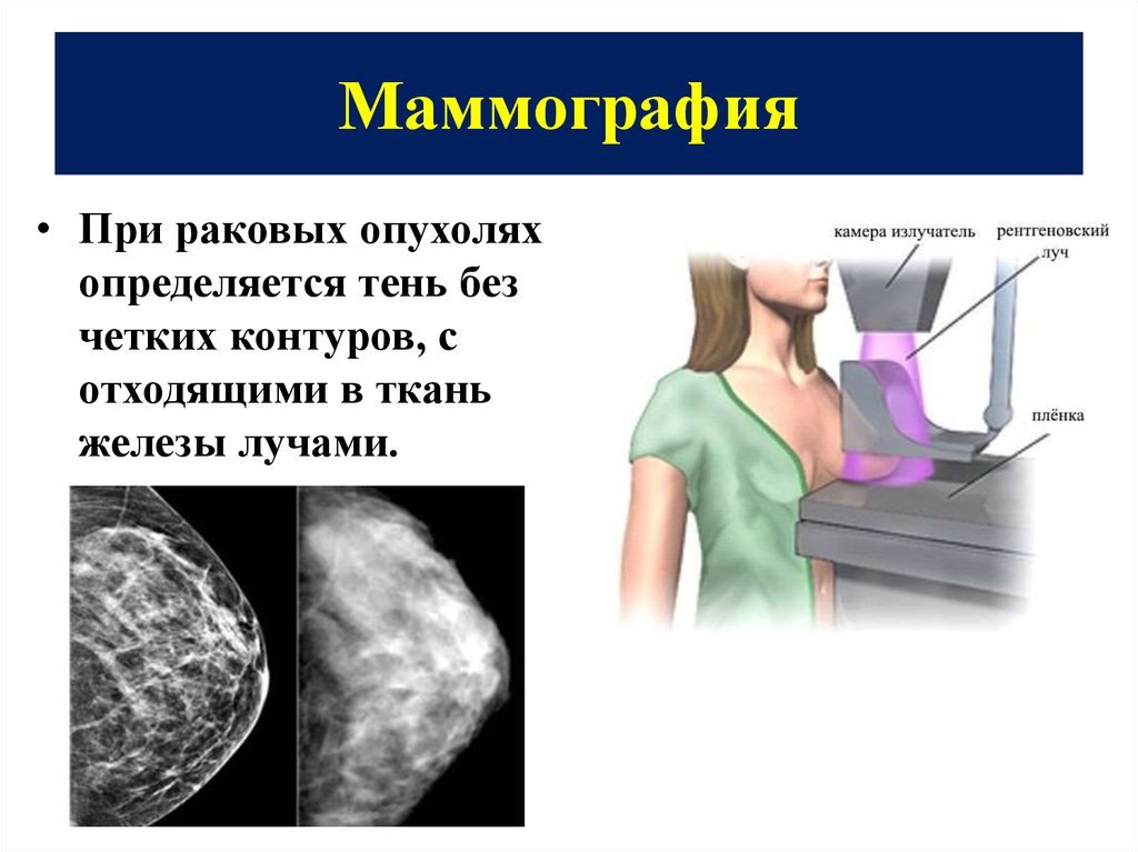 Маммография ответы. Маммографическое исследование молочных желез. Рентгеновская маммография. Маммография молочных желез. Рентгенологическое исследование молочной железы.