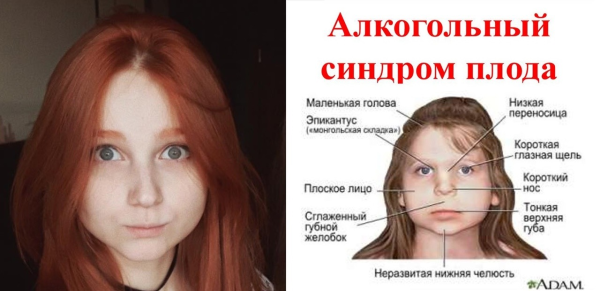 Эвелинушка алкогольный синдром