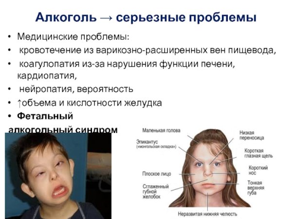Фетальный алкогольный синдром у Натальи Водяновой