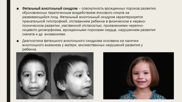 Фетальный алкогольный синдром признаки