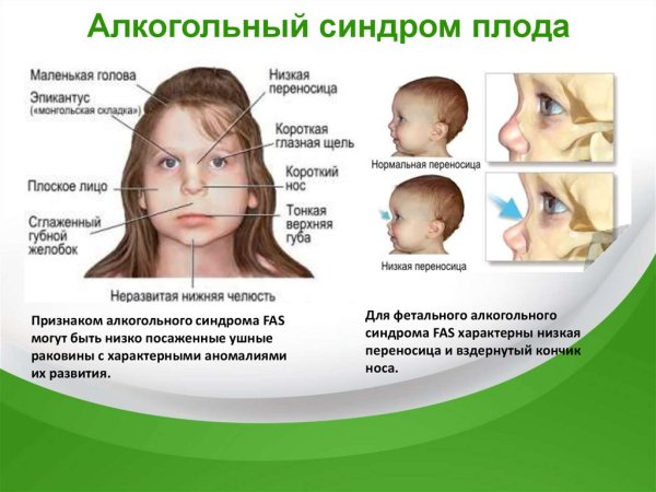 ФАС фетальный алкогольный синдром