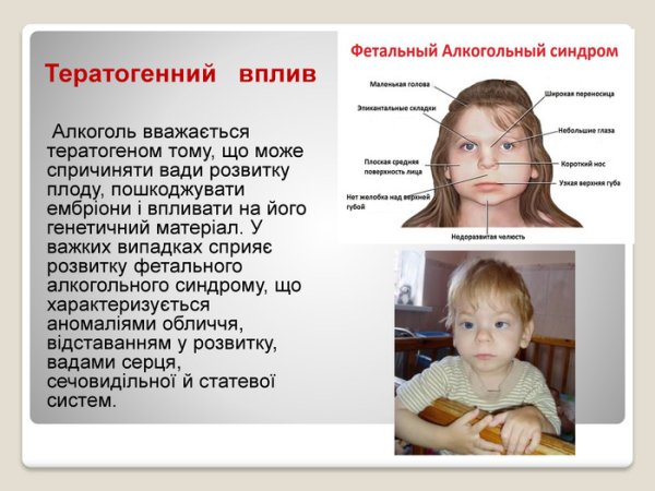 Фетальный алкогольный спектр нарушений