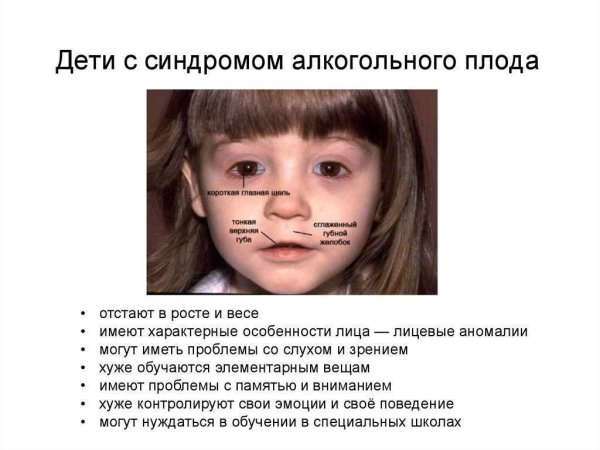 Алкогольный синдром плода (фетальный алкогольный синдром).