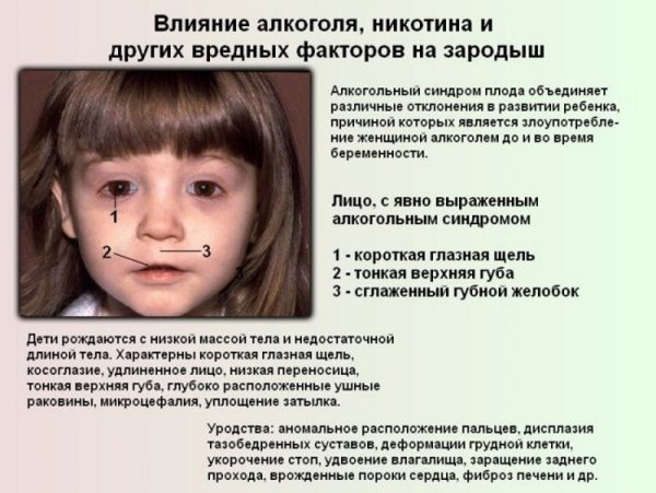 Фетальный алкогольный синдром плода