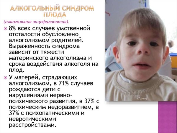 Фетальный алкогольный синдром