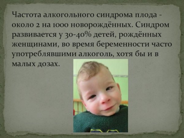 Алкогольный синдром плода