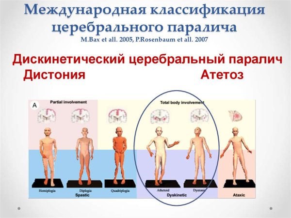 Классификация ДЦП
