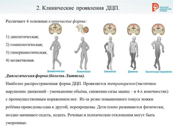 Гиперкинетическая форма при ДЦП