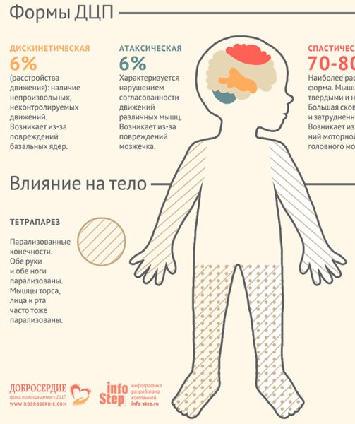 Формы детского церебрального паралича