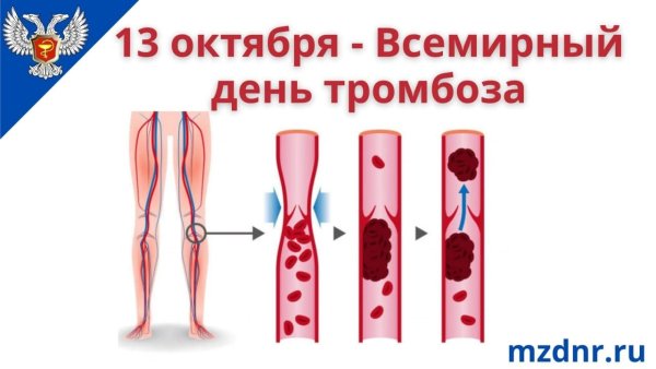 Всемирный день борьбы с тромбозом